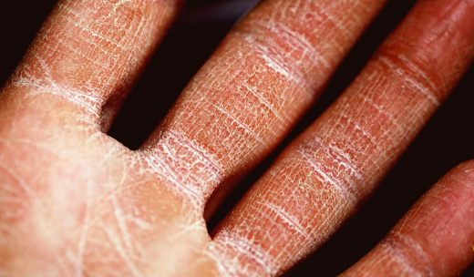 Primer plano de una mano con piel seca