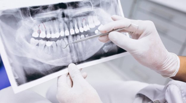 Primer plano de una radiografía de los dientes de una persona adulta